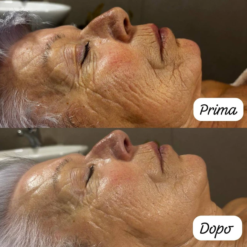 Prima e Dopo Peeling